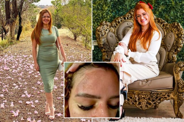 Horror quando a explosão da panela de pressão deixa a influenciadora com queimaduras 'agonizantes' no rosto e no peito

